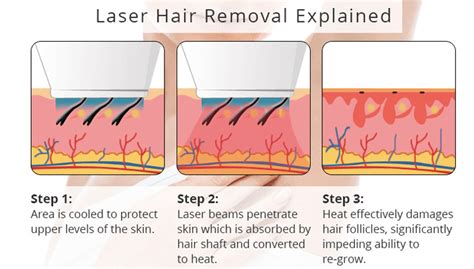 FAQ (Frequently Asked Questions) Permanent and Less Painful Laser Hair Removal